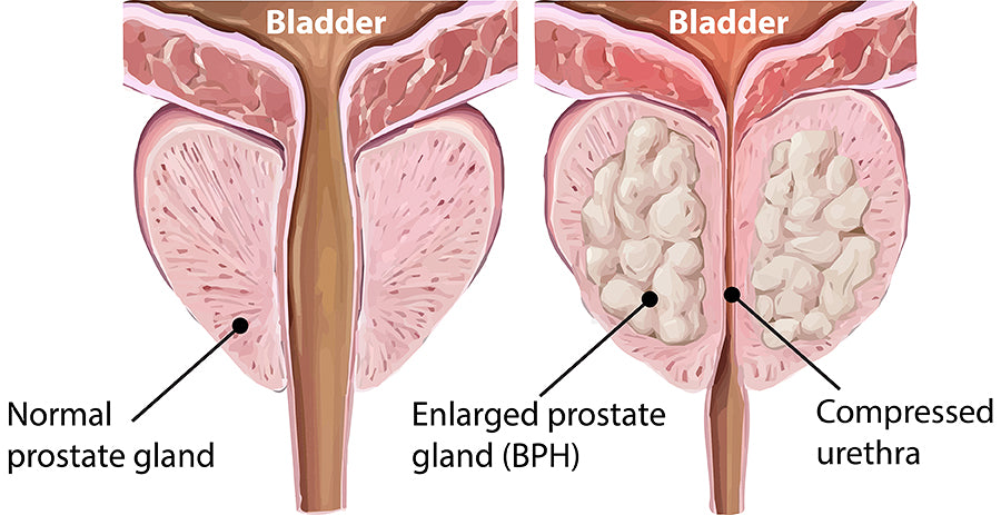HOW DIET HELPS A HEALTHY PROSTRATE